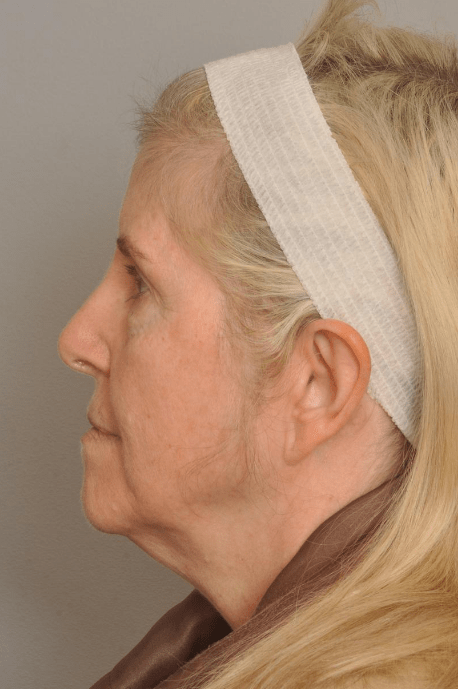 Brow Lift Delaware | Premier Cosmetic Surgery DE