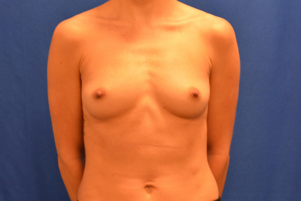 Breast Augmentation Delaware | Premier Cosmetic Surgery DE