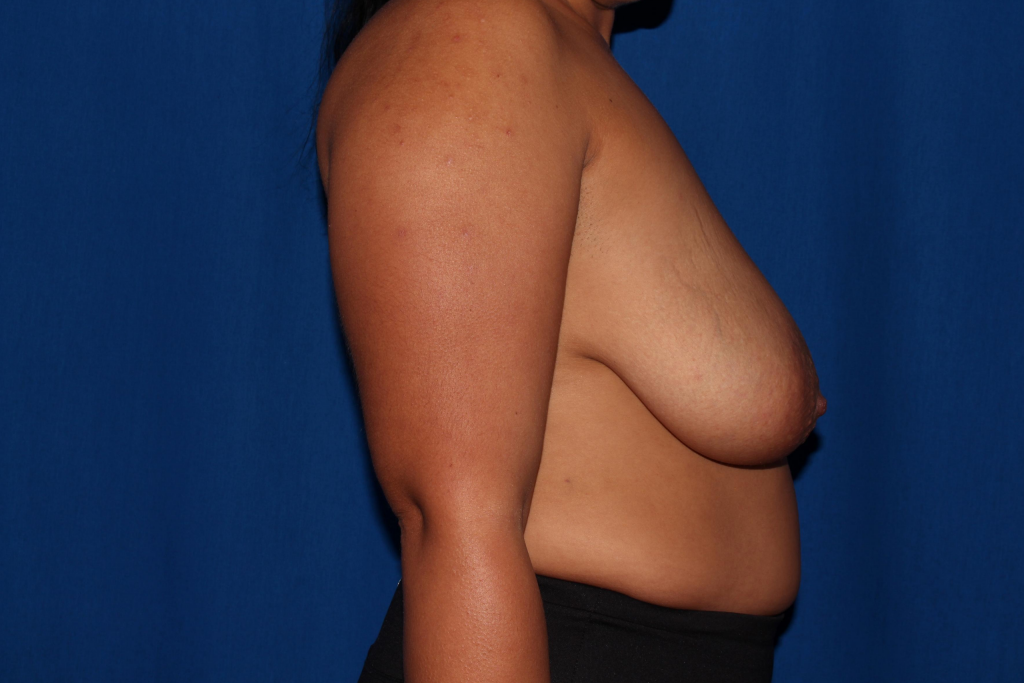 Breast Reduction Delaware | Premier Cosmetic Surgery DE
