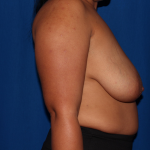 Breast Reduction Delaware | Premier Cosmetic Surgery DE
