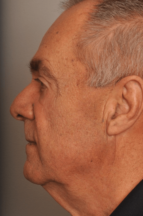 Mole/Lesion Removal Delaware | Premier Cosmetic Surgery DE