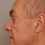 Mole/Lesion Removal Delaware | Premier Cosmetic Surgery DE