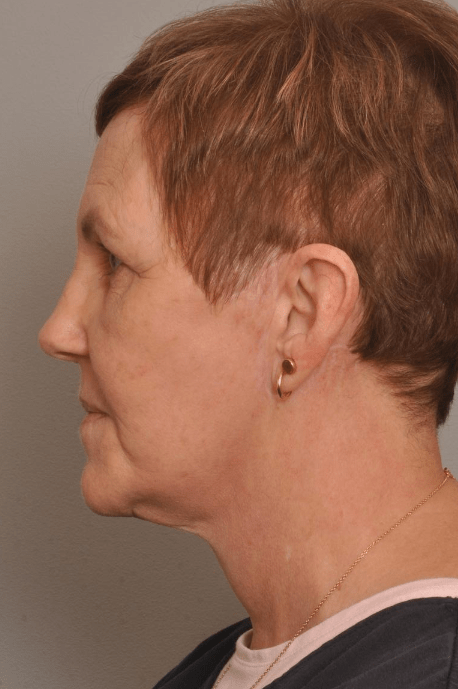 Lower Facelift/Necklift Delaware | Premier Cosmetic Surgery DE
