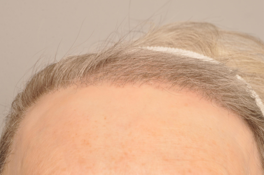 Hair Restoration Delaware | Premier Cosmetic Surgery DE