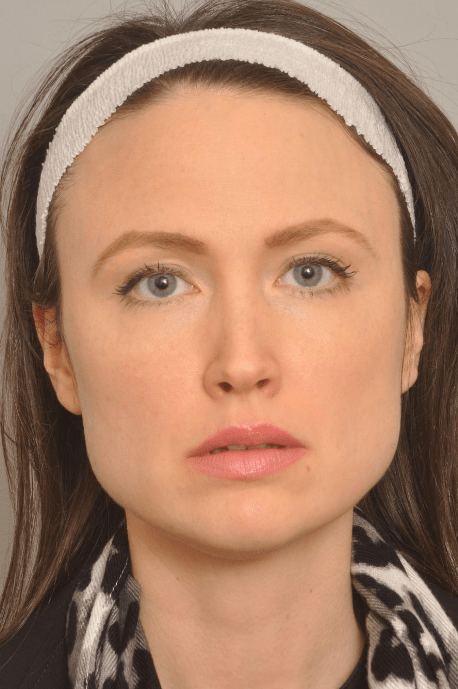 Kybella Delaware | Premier Cosmetic Surgery DE