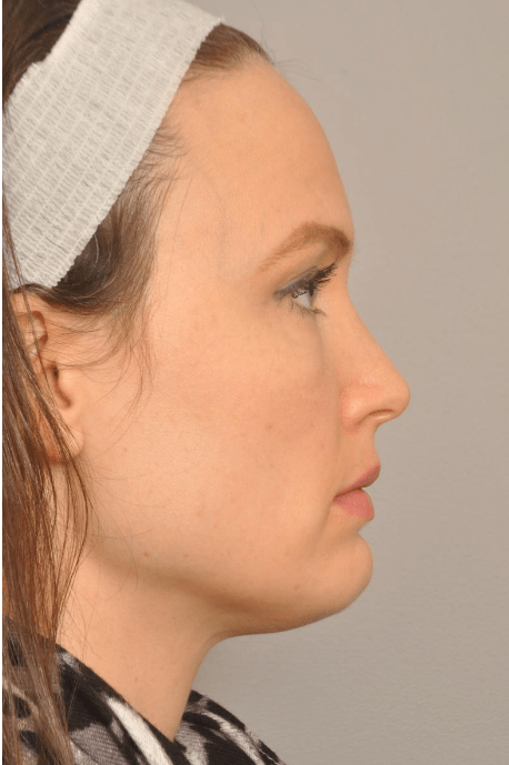 Kybella Delaware | Premier Cosmetic Surgery DE