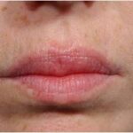 Lip Augmentation Delaware | Premier Cosmetic Surgery DE