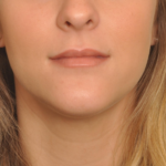 Lip Fillers Delaware | Premier Cosmetic Surgery DE