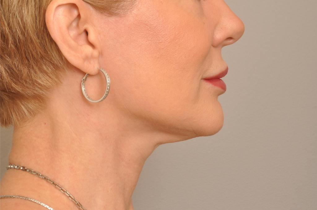 Lip Fillers Delaware | Premier Cosmetic Surgery DE