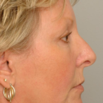 Mid Face Lift Delaware | Premier Cosmetic Surgery DE