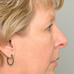Mid Face Lift Delaware | Premier Cosmetic Surgery DE