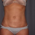 Mini Tummy Tuck Delaware | Premier Cosmetic Surgery DE
