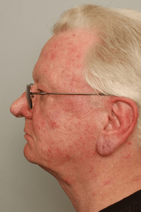 Rhinophyma Delaware | Premier Cosmetic Surgery DE