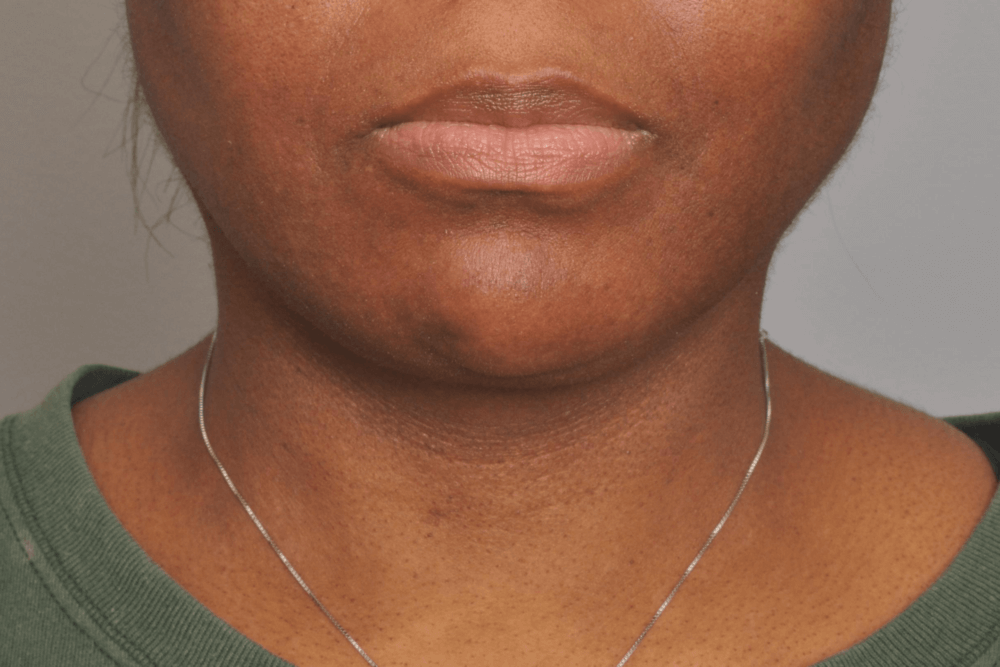 Facial Liposuction Newark DE | Gallery | Premier Cosmetic Surgery DE