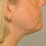 Liposuction Delaware | Premier Cosmetic Surgery DE