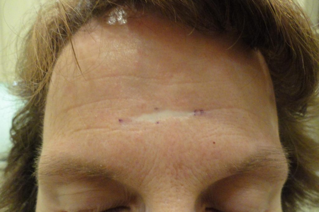 Scar Revision Delaware | Premier Cosmetic Surgery DE