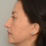 Blepharoplasty Eyelid Surgery | Premier Cosmetic Surgery DE