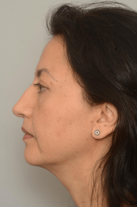 Blepharoplasty Eyelid Surgery | Premier Cosmetic Surgery DE