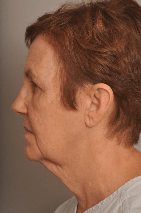 Lower Facelift/Necklift Delaware | Premier Cosmetic Surgery DE