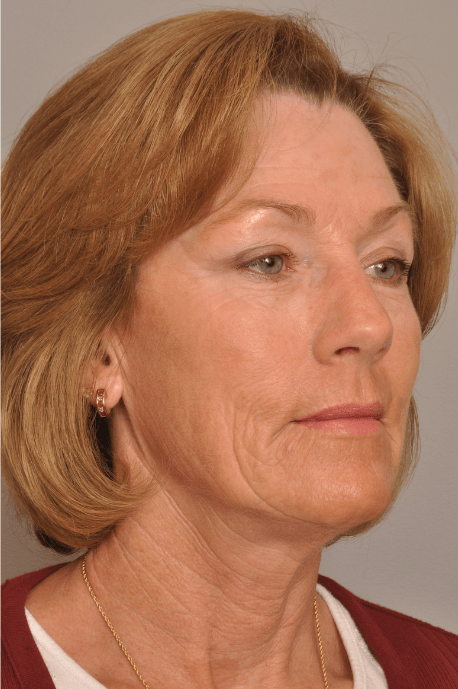 Brow Lift Delaware | Premier Cosmetic Surgery DE
