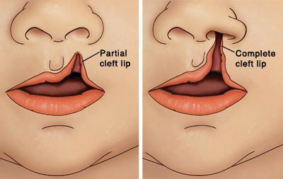 Clift Lip Nose Repair Delaware | Premier Cosmetic Surgery DE